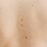 P2-DE Derma Paket