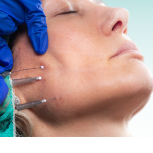 F3-DE Fadenlifting Onlinekurs